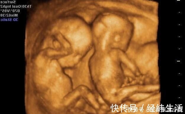 产检|孕期产检不想生个“傻孩子”,这三项产检必须按时做,不能忽视