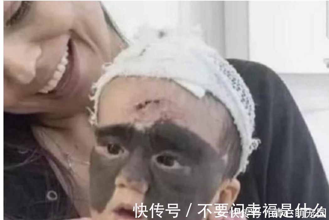 整容|女婴一出生伴随“蝙蝠侠印记”,被父母送去整容7次,结果怎样了