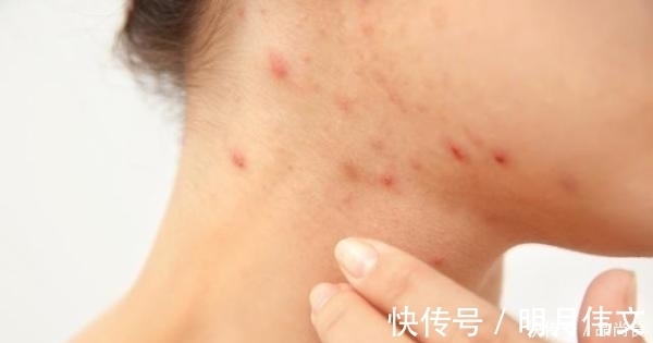 床上螨虫太多?教你3个不要钱的“土法子”, 把螨虫“赶尽杀绝”