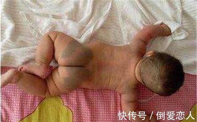 胎记|孩子出生身上有胎记,是孕期做这些事造成的,很多宝妈没在意