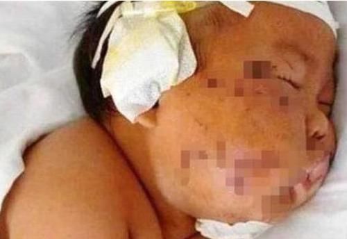 产妇|因吃奶咬疼妈妈,被划成“花脸猫”的男孩,如今四岁现状如何?