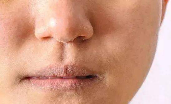 反黑 做完光子嫩肤之后反黑了怎么办呐?什么是反黑?术后该如何护理?