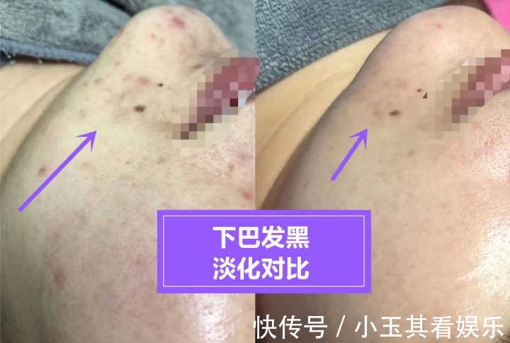 美白|嘴唇周围发黑是怎么回事?如何美白呢?