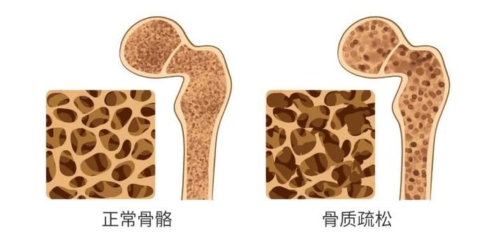 腰酸腿|光补钙没用！预防骨质疏松的这几大误区你都知道吗