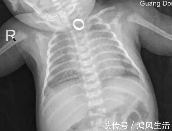 食管|乐极生悲！满月宝宝戴5只金戒指后吞下一只！这习俗太危险