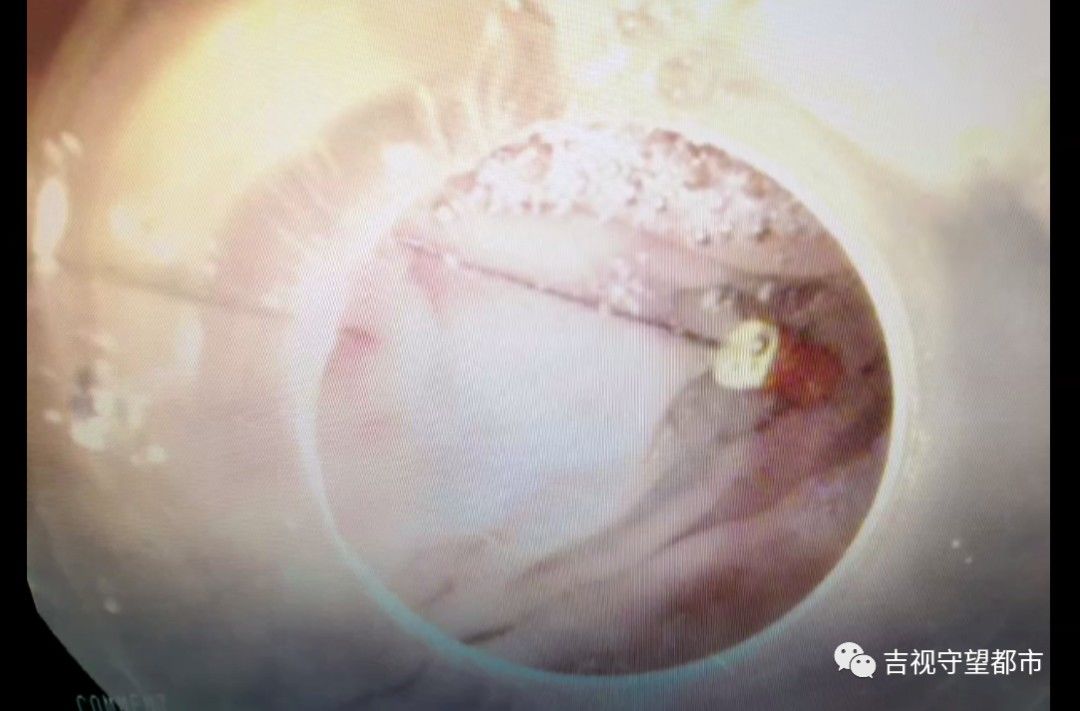 消化道|牙修一半针没了！胃内发现修牙针...