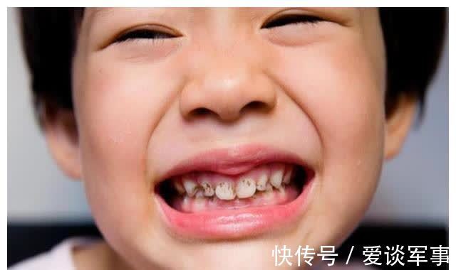 孩子换牙要不要干预?若碰上这些情况,最好能及早干预