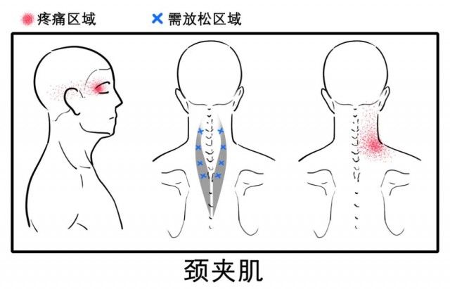 颈椎|八成头痛和颈椎有关！一份“疼痛位置图解”帮你对症放松