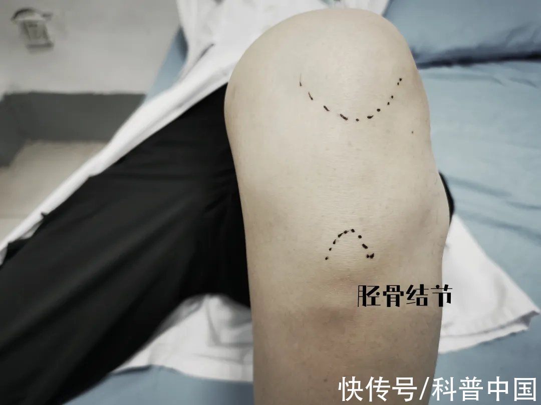 胫骨|为长高,让孩子每天跳绳3000个,患上这种病,严重可致畸形