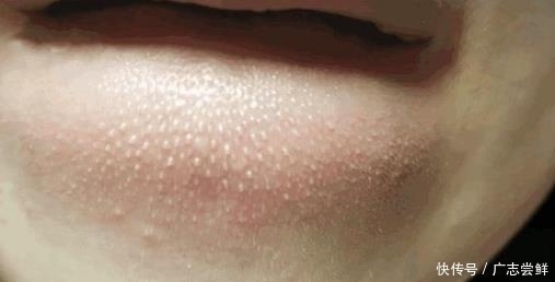 抿紧下巴后突起的“白疙瘩”，千万要注意，这是螨虫的真身吗？