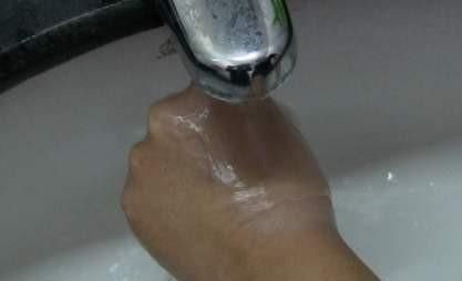 皮肤|突发情况意外烫伤怎么处理这几个应急方法都很管用