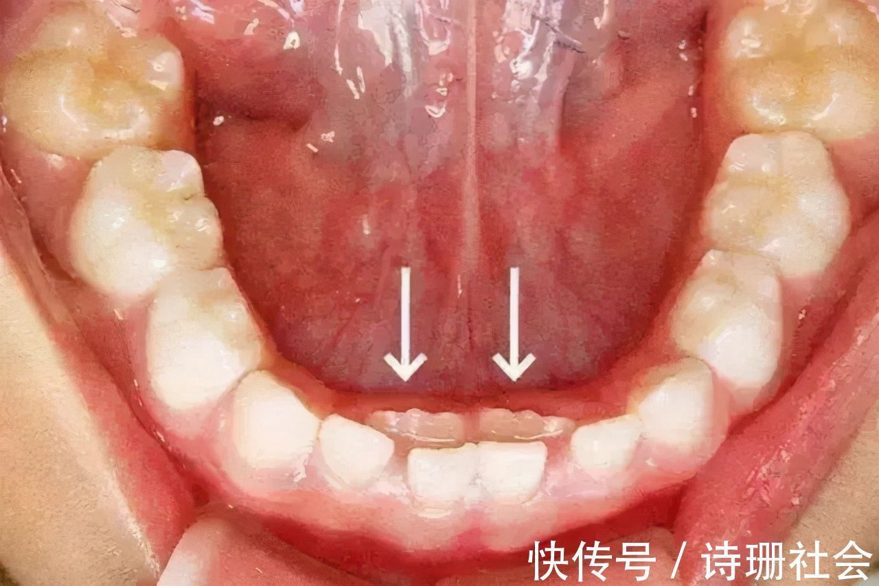 牙胚|孩子长出“双排牙”太难看？是乳牙脱落太晚导致的，需要适当刺激