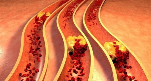 血脂|高血脂患者,如何减少血栓风险除了控制血脂,还要注意这些方面