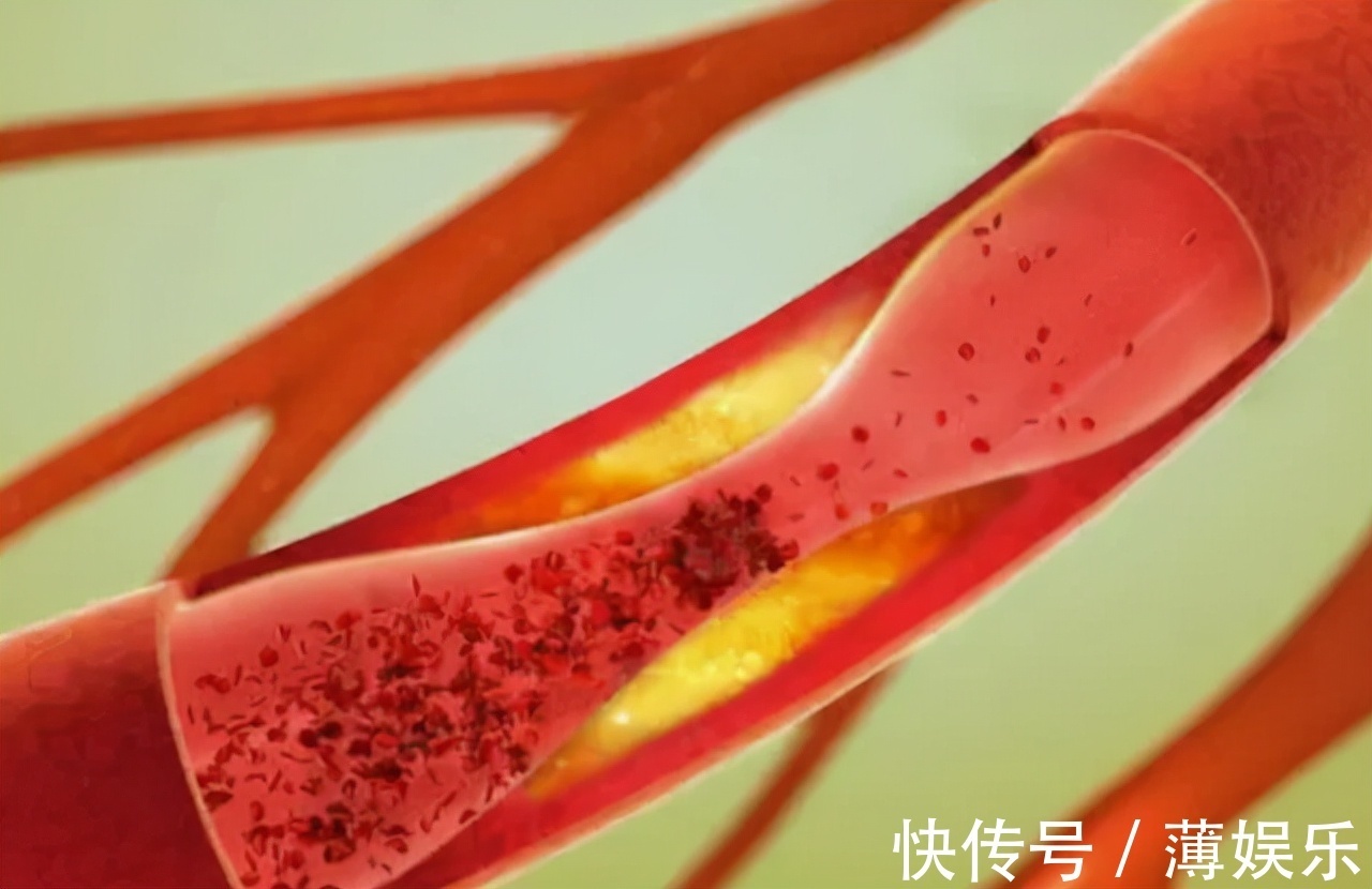 油脂|多走路能降血脂医生提醒日常多吃这4物,或比走路效果好