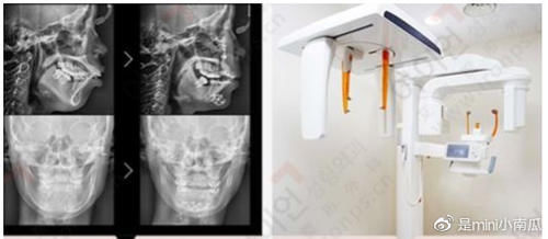 之前做下颌角后出现左右脸不对称，这种情况能恢复吗？