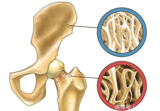 动脉硬化|预防骨质疏松,这1个水果就可以解决,但这4个字能做到的人不多