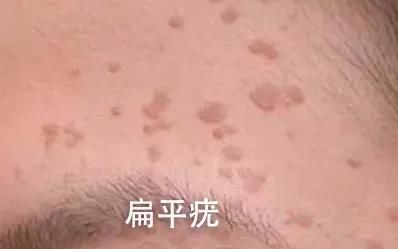 hpv|皮肤上长这种「小疙瘩」，可能和HPV感染有关……