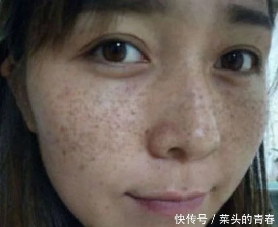 脸上长斑不要慌,巧用维E加生姜,仅需每晚敷下脸7天淡斑没风险