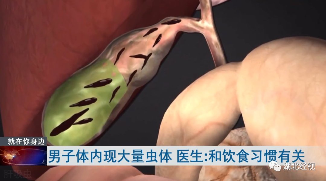 佳木斯|男子体内出现大量活寄生虫!和这种饮食习惯有关