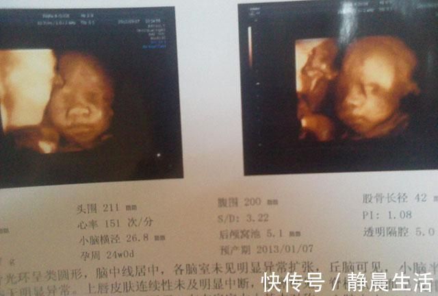 叶酸|孕检需要做，但这3种实在没必要，不仅没什么大用，还费钱费时