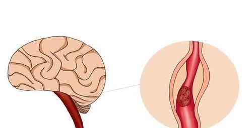 耳石症|经常头晕,是不是“脑供血不足”?医生告诉你:真不是