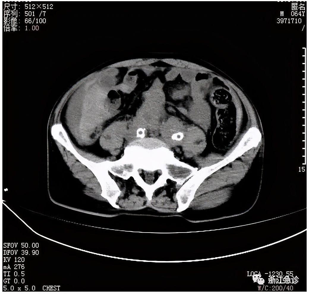 心肺复苏|小小背痛潜伏的巨大隐患，急诊医生最艰难的生死抉择
