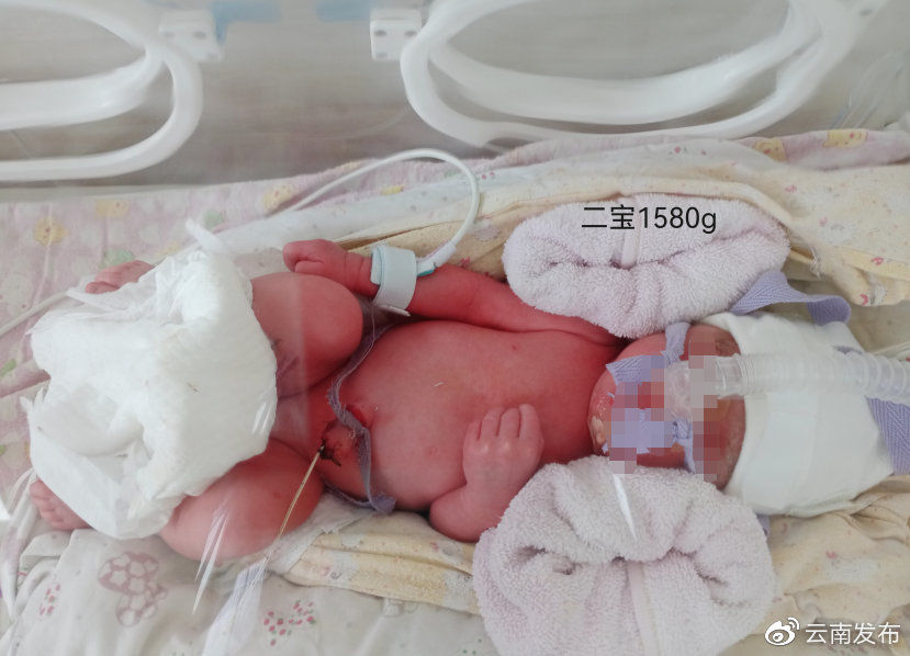 瑞丽|全国首例新冠肺炎确诊三胞胎孕妇在瑞丽顺利生产