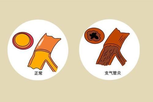 肺部|做CT时,报告显示两肺纹理增粗,说明了什么?