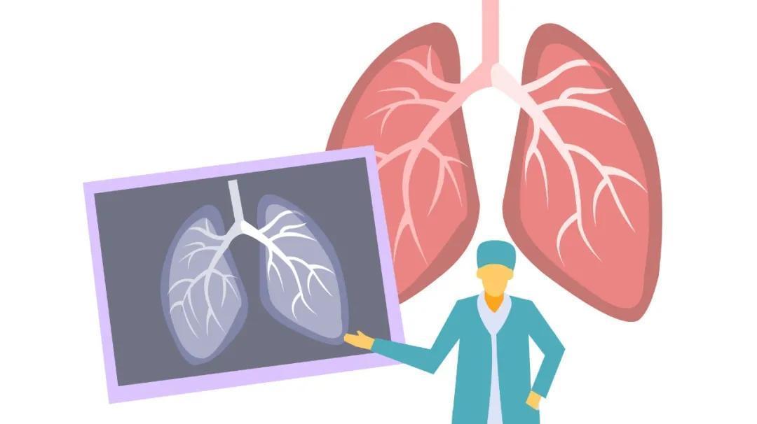 有肺结节的人,都值得看一看
