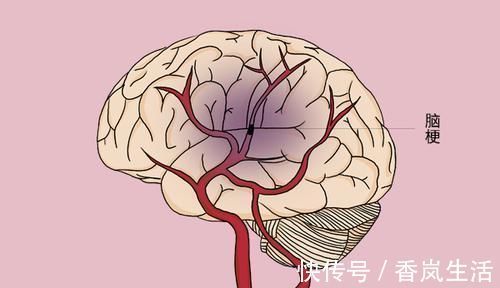 预警|身体突然出现4个“异样”,十有八九是脑梗预警,需尽快就医