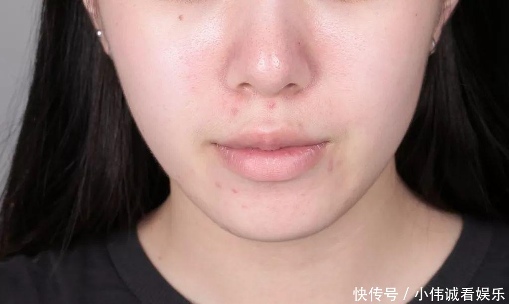 防晒|脸上残留“红色痘印”,你却还在疯狂“美白”?怪不得消不下去