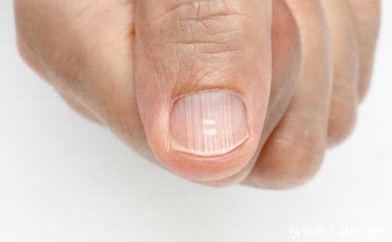 增加|为什么中国“肝癌”数量急剧增加医生提醒只怪常忽略4个症状