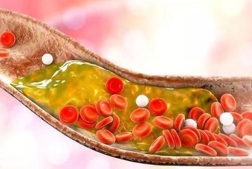 碳水化合物|比肥肉还“升血脂”?医生提醒:高血脂的人,尽量少碰“1素”!