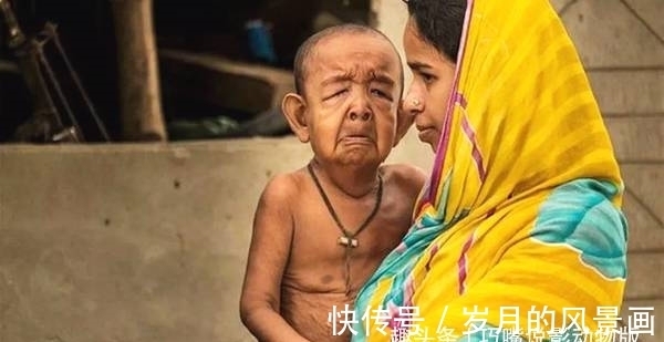 儿童早衰症|印度男童,患怪病,智商超群却长着一副80岁面孔