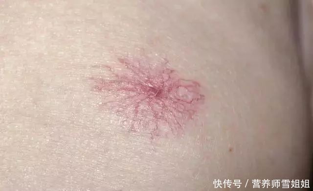  拖延|喝酒的人，出现“1痣、2痛、3多”，去查查肝脏，别忽视拖延