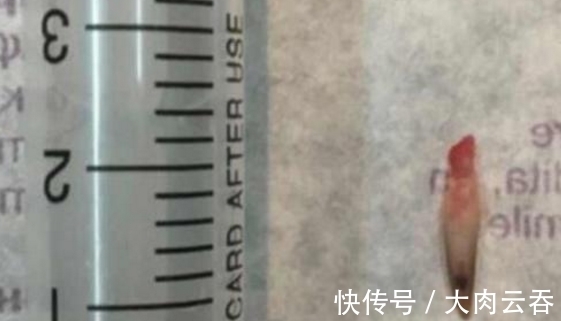 指甲|男子的指甲上长出“小手指”,去医院检查后,医生也是第一次看到