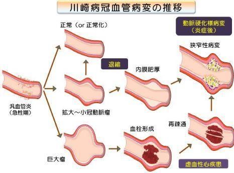 把这个病当普通感冒治，后果很严重！