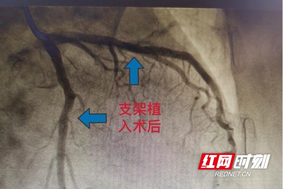 弥漫性|临澧县中医医院心血管内科为八旬老太成功实施冠脉支架植入术