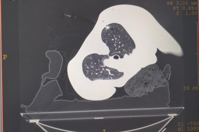 肺部小结节|大医说丨定位“神针”加微孔，胸腔镜微创手术解决肺小结节治疗难题