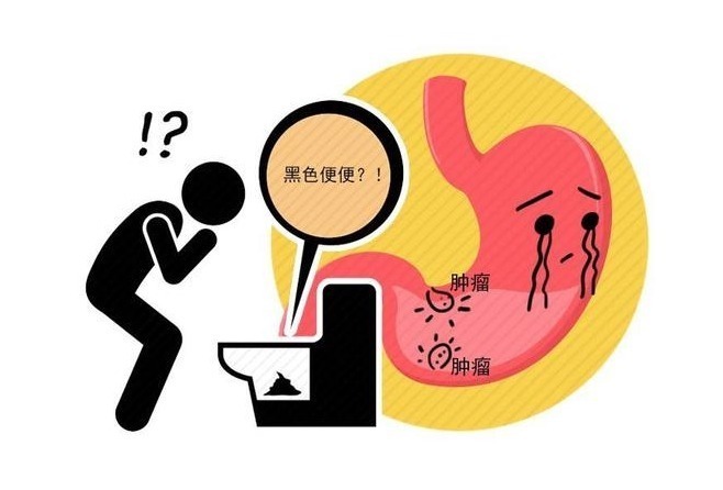 上腹|是胃癌,还是胃炎,傻傻分不清!医生介绍:看好几点,别再混淆