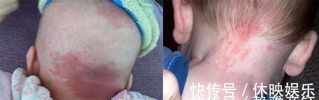 皮肤病|发现新生儿小屁屁上有“淤青”,老公想找护士理论,最后暗暗庆幸