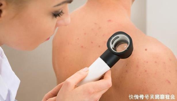 痘痘|后背痒抠下小颗粒，后背沦为螨虫“江山”，2洗1吃，螨虫将蹭蹭掉