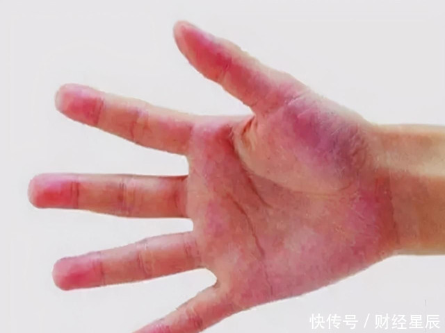 直言|脂肪肝置之不理,拖成肝硬化,医生直言:远离3个不良习惯
