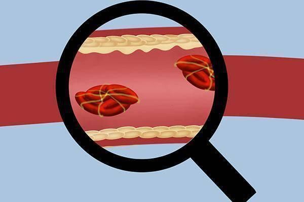 高手|天然溶栓高手现身,不是洋葱木耳,坚持吃点,血管通畅远离血栓