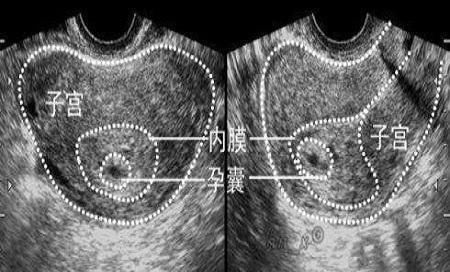 b超|怀孕后孕囊发育很重要，多久才能看见孕囊？为什么说孕囊很重要？