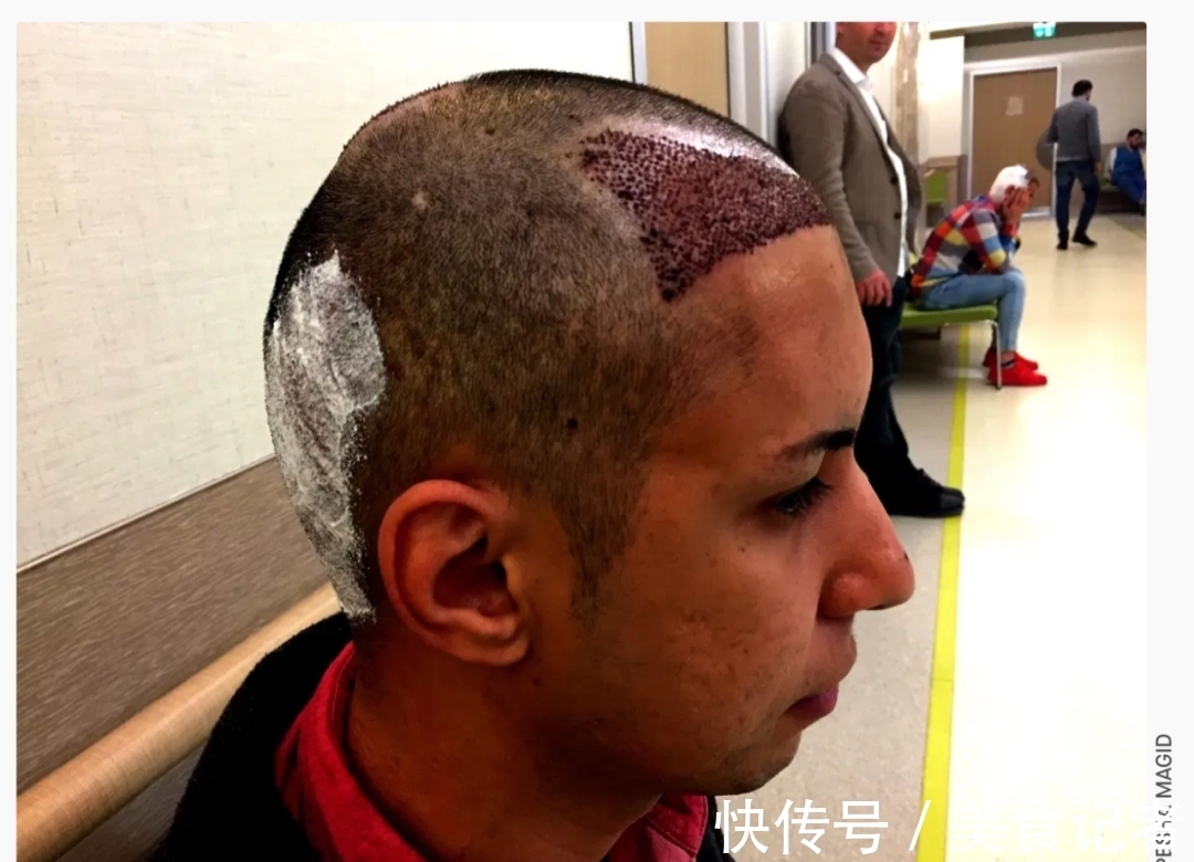 chris 每个月到底有多少人去土耳其植发？
