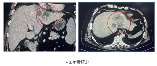 胸腔|肝脓肿患者命悬一线，多学科全力救治后重获新生