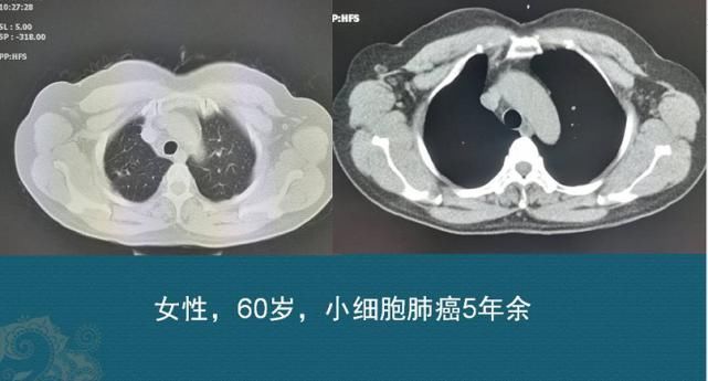 癌症|查出癌症不放疗不化疗，保持良好心态吃喝玩乐，能扛过去吗