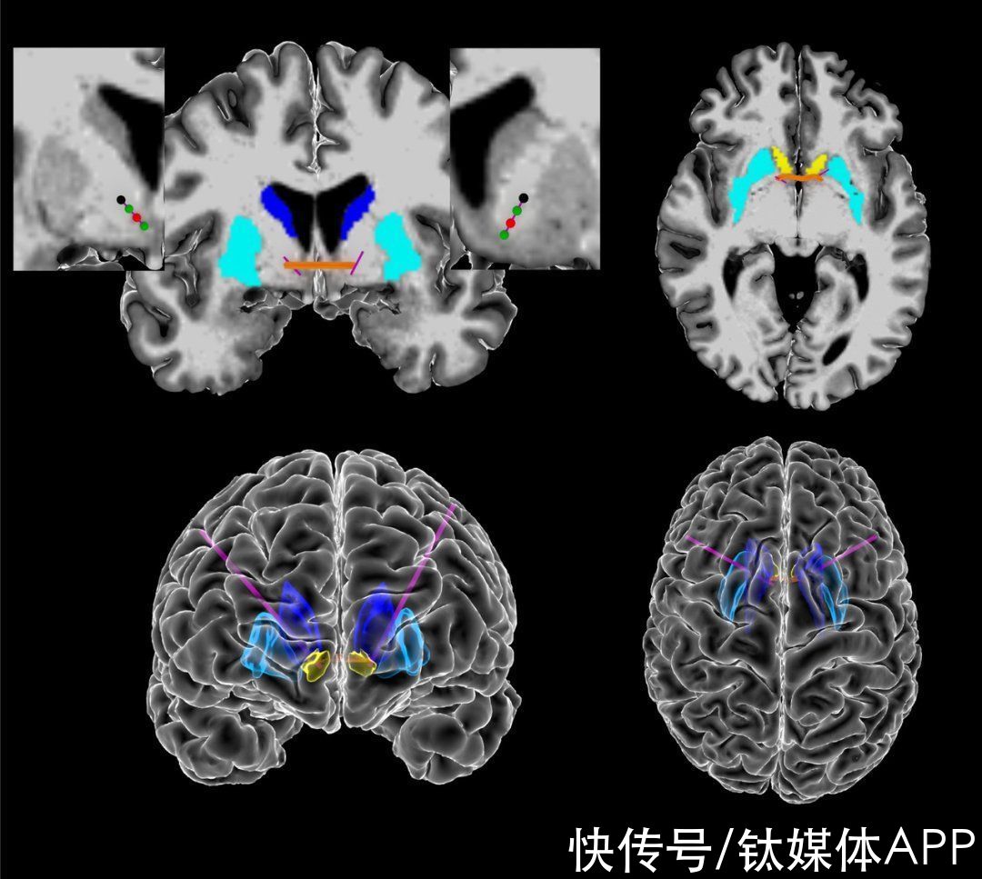 AI遇上强迫症，大脑与情绪的羁绊有解了