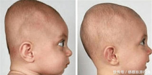 预防颈椎病|“睡枕头”和“不睡枕头”的孩子,长大后到底差别在哪里